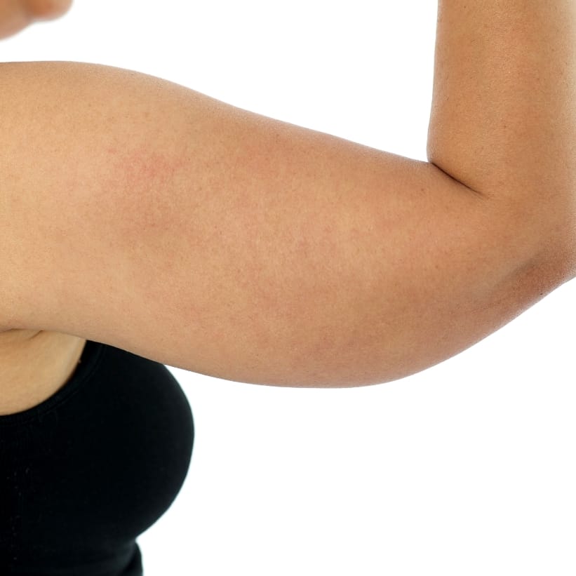 Elbow fat reduction hotsell